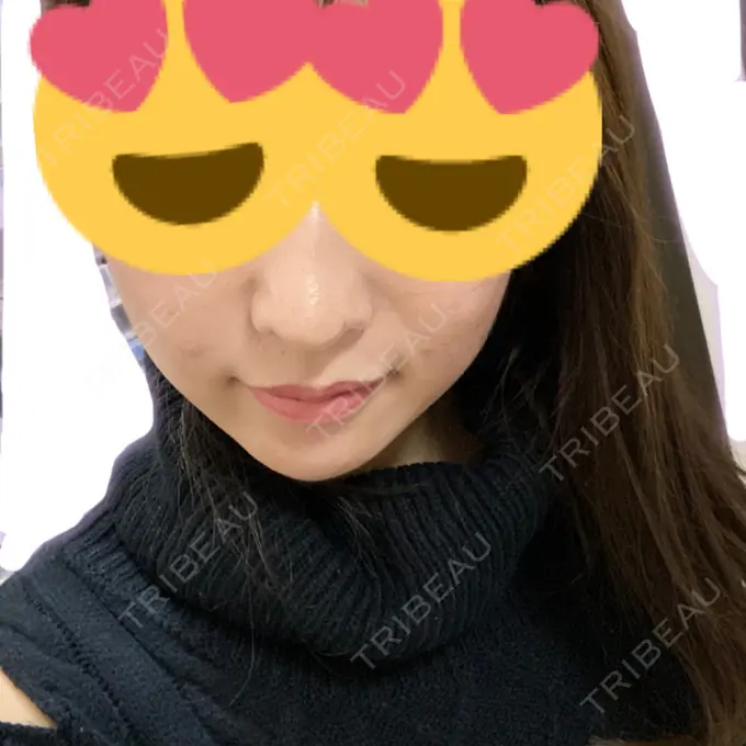 糸リフト / ボトックス（あご） / 肌ヒアルロン酸注入（たるみ・シワ改善） / ヒアルロン酸注入（あご） / ヒアルロン酸注入（唇） / ボトックス（口角） ルラ美容クリニック 新宿院 DAY 10 メイン用