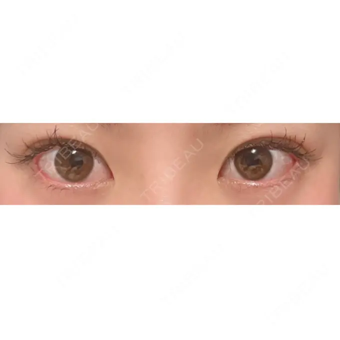 目尻切開 / タレ目形成・グラマラスライン（切開） A CLINIC（エークリニック） 銀座院 DAY 14 メイン用