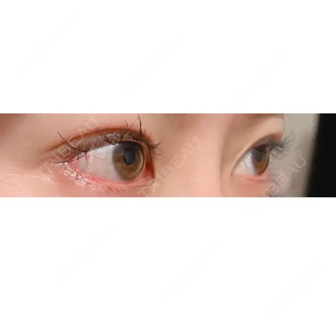 目尻切開 / タレ目形成・グラマラスライン（切開） A CLINIC（エークリニック） 銀座院 DAY 14 メイン用