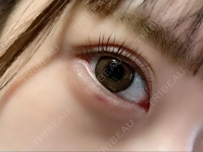 ヒアルロン酸注入（涙袋） 湘南美容クリニック 大阪あべの院 DAY 0 メイン用