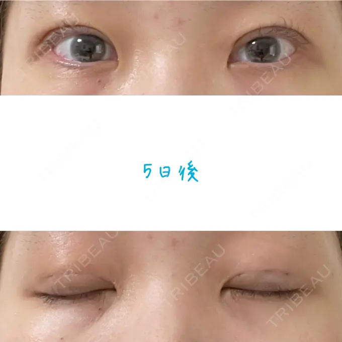 二重埋没 湘南美容クリニック 大阪あべの院 DAY 5 メイン用