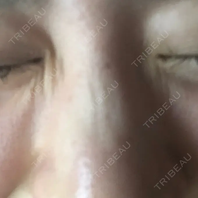 ボトックス（あご） 湘南美容クリニック 銀座院 DAY 13 メイン用