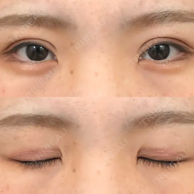 二重切開 城本クリニック 福岡院 DAY 41 メイン用