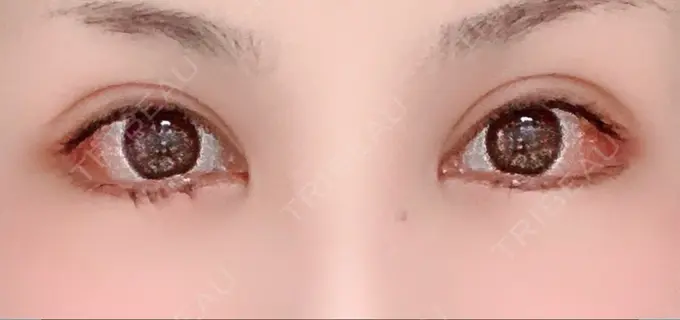 目尻切開 / タレ目形成・グラマラスライン（切開） 高須クリニック 大阪院 DAY 6 メイン用