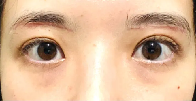 眉下切開 Taide Suenaga Clinic（タイデスエナガクリニック） DAY 50 メイン用