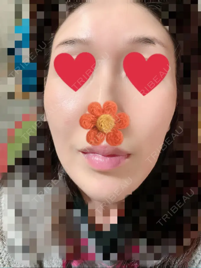 ピーリング（ニキビ・毛穴） / イオン導入 / エレクトロポレーション / 毛穴洗浄（ハイドラフェイシャルなど） あおばクリニック 横浜院 AFTER メイン用