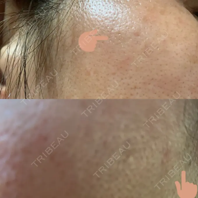 ピーリング（ニキビ・毛穴） / イオン導入 / エレクトロポレーション / 毛穴洗浄（ハイドラフェイシャルなど） あおばクリニック 横浜院 DAY 28 メイン用