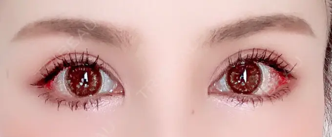 目尻切開 / タレ目形成・グラマラスライン（切開） 高須クリニック 大阪院 DAY 8 メイン用