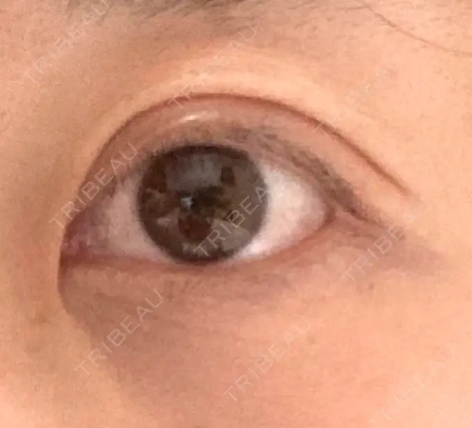 眼瞼下垂（切開） 銀座すみれの花 形成クリニック DAY 41 メイン用