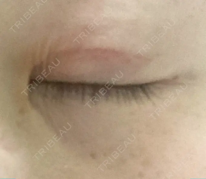 眼瞼下垂（切開） 銀座すみれの花 形成クリニック DAY 41 メイン用