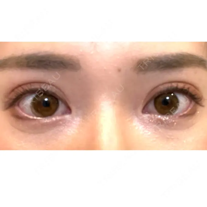 二重埋没 ハナビューティークリニック AFTER メイン用