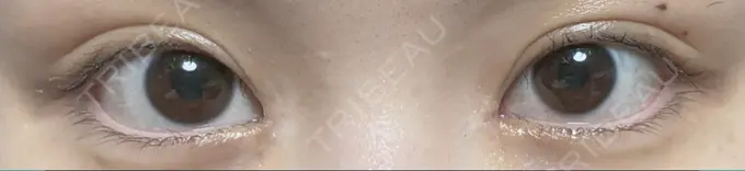 蒙古ひだ形成 R.O.clinic DAY 21 メイン用