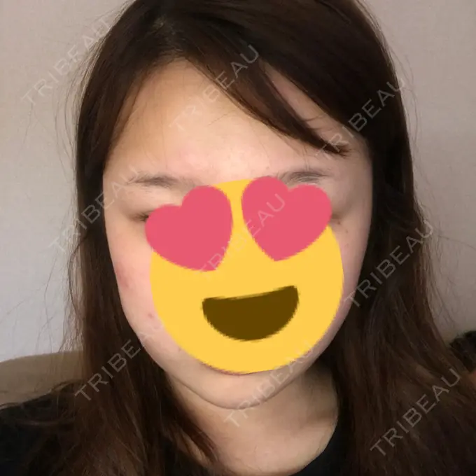 脂肪吸引（顔） 湘南美容クリニック 銀座院 DAY 29 メイン用