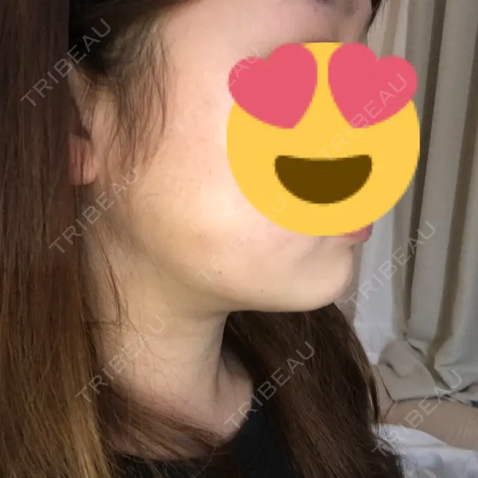 脂肪吸引（顔） 湘南美容クリニック 銀座院 DAY 29 メイン用