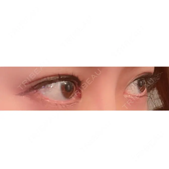 目尻切開 / タレ目形成・グラマラスライン（切開） A CLINIC（エークリニック） 銀座院 DAY 15 メイン用