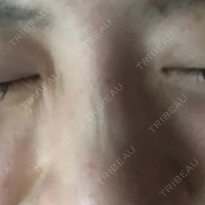 ボトックス（あご） 湘南美容クリニック 銀座院 AFTER メイン用