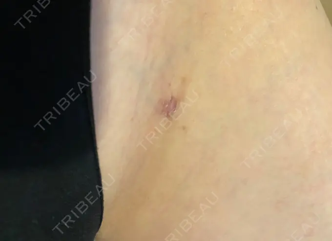 脂肪吸引（脚） 湘南美容クリニック 新橋銀座口院 DAY 20 メイン用