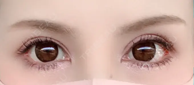 目尻切開 / タレ目形成・グラマラスライン（切開） 高須クリニック 大阪院 DAY 10 メイン用