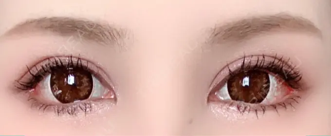 目尻切開 / タレ目形成・グラマラスライン（切開） 高須クリニック 大阪院 DAY 11 メイン用