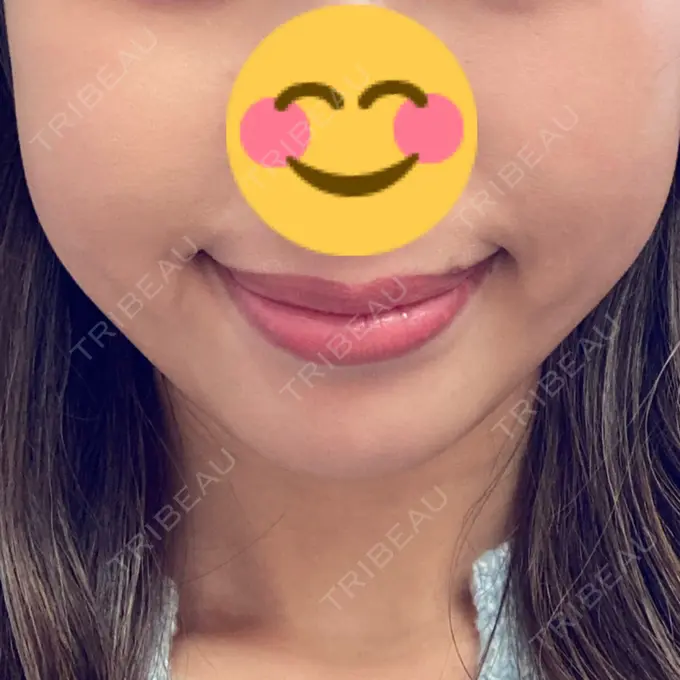 脂肪溶解注射（顔） 大西皮フ科形成外科医院 滋賀大津石山院 DAY 24 メイン用