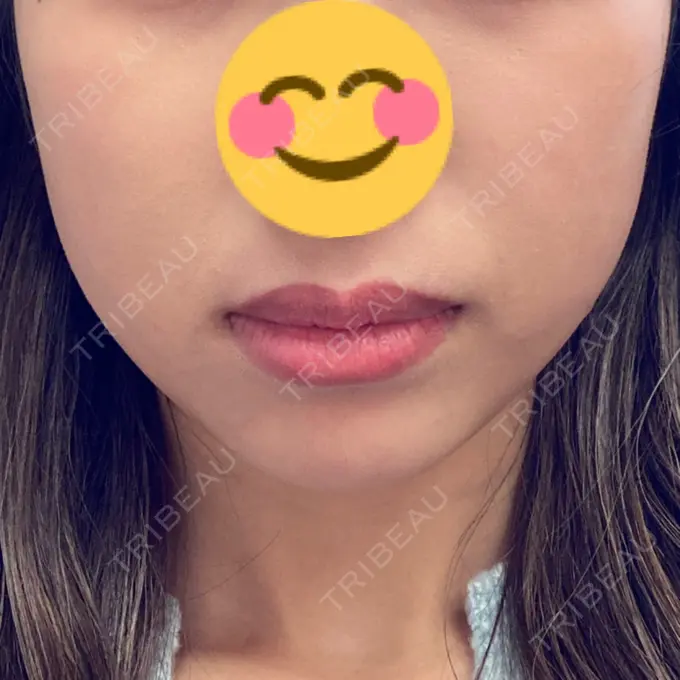 脂肪溶解注射（顔） 大西皮フ科形成外科医院 滋賀大津石山院 DAY 24 メイン用