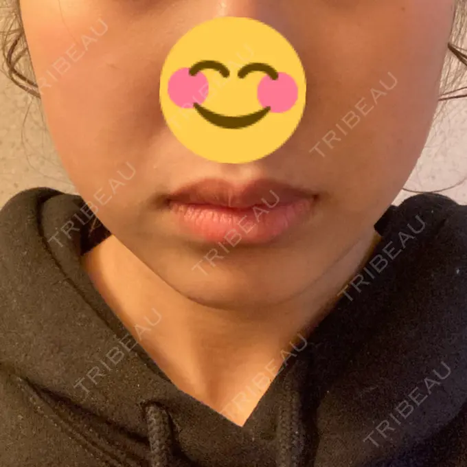 脂肪溶解注射（顔） 大西皮フ科形成外科医院 滋賀大津石山院 DAY 26 メイン用