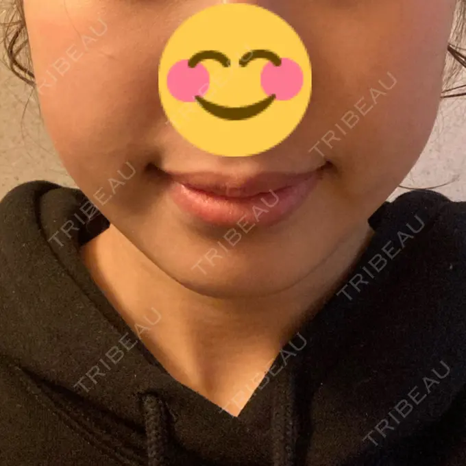 脂肪溶解注射（顔） 大西皮フ科形成外科医院 滋賀大津石山院 DAY 26 メイン用