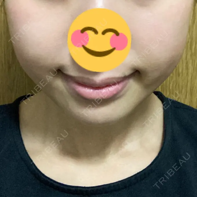 脂肪溶解注射（顔） 大西皮フ科形成外科医院 滋賀大津石山院 DAY 29 メイン用