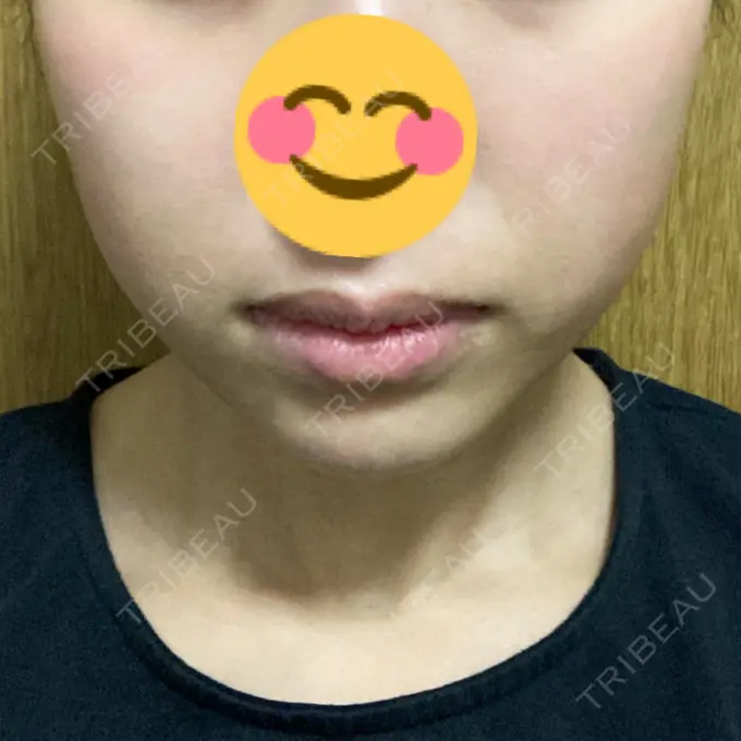 脂肪溶解注射（顔） 大西皮フ科形成外科医院 滋賀大津石山院 AFTER メイン用