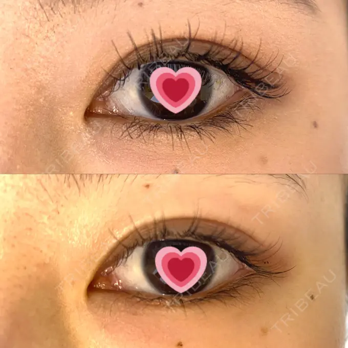 二重埋没 MIYAフェイスクリニック AFTER メイン用