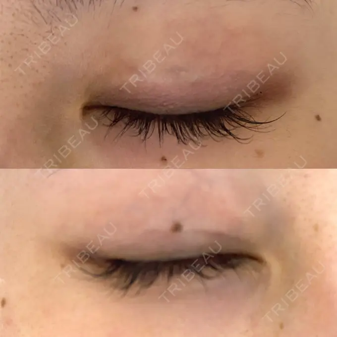 二重埋没 MIYAフェイスクリニック DAY 691 メイン用