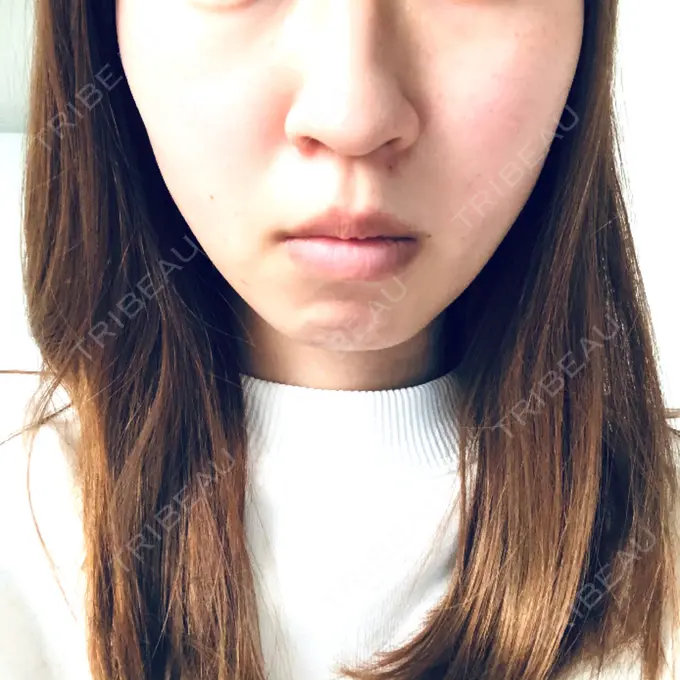 糸リフト 湘南美容クリニック 東京蒲田院 DAY 21 メイン用