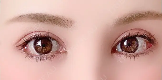 目尻切開 / タレ目形成・グラマラスライン（切開） 高須クリニック 大阪院 DAY 12 メイン用