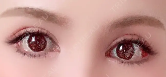 目尻切開 / タレ目形成・グラマラスライン（切開） 高須クリニック 大阪院 AFTER メイン用