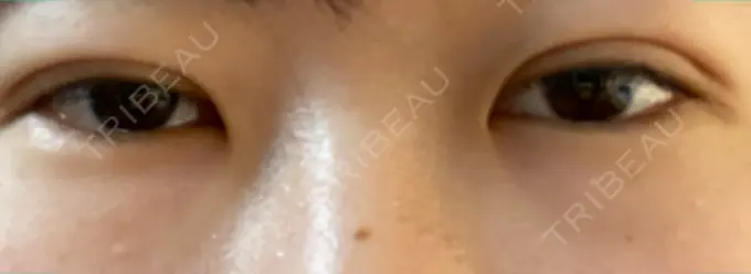 二重埋没 湘南メディカル記念病院（両国） DAY 0 メイン用