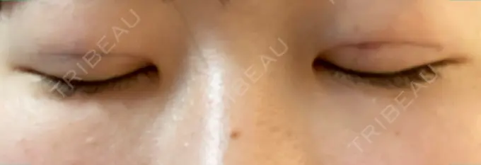 二重埋没 湘南メディカル記念病院（両国） DAY 0 メイン用