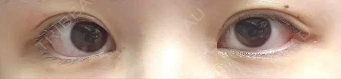 蒙古ひだ形成 R.O.clinic DAY 25 メイン用