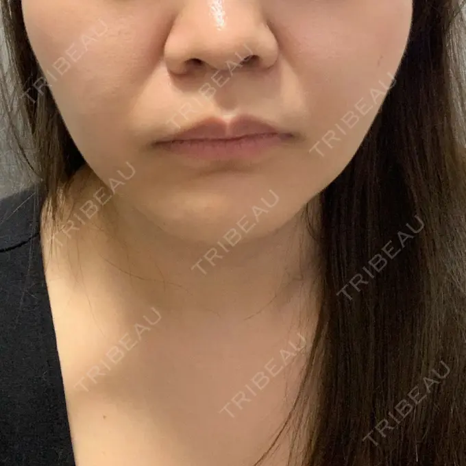 糸リフト / バッカルファット除去 / 脂肪吸引（顔） / メーラーファット除去 / ボトックス（エラ・小顔） 湘南美容クリニック 秋葉原院 AFTER メイン用