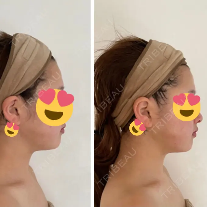 脂肪吸引（顔） 湘南美容クリニック 銀座院 DAY 29 メイン用