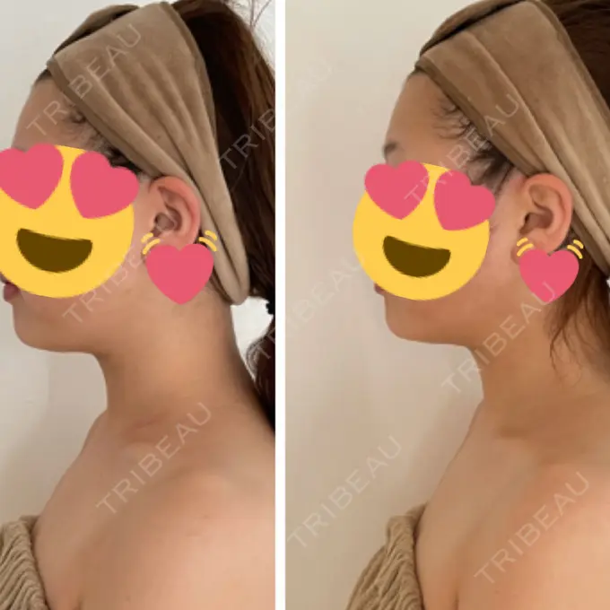 脂肪吸引（顔） 湘南美容クリニック 銀座院 DAY 29 メイン用