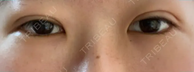 二重埋没 湘南メディカル記念病院（両国） DAY 1 メイン用