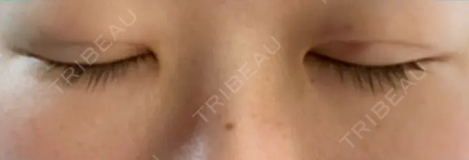 二重埋没 湘南メディカル記念病院（両国） DAY 1 メイン用