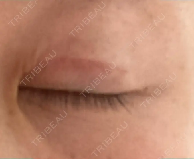 眼瞼下垂（切開） 銀座すみれの花 形成クリニック DAY 47 メイン用