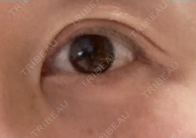 眼瞼下垂（切開） 銀座すみれの花 形成クリニック DAY 47 メイン用