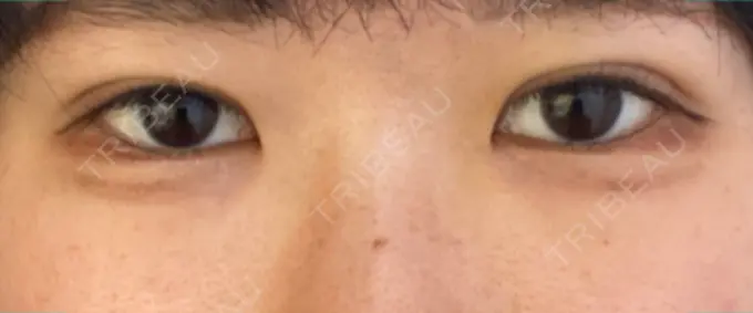 二重埋没 湘南メディカル記念病院（両国） DAY 2 メイン用