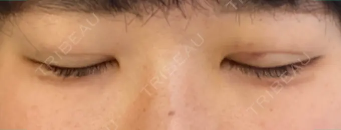 二重埋没 湘南メディカル記念病院（両国） AFTER メイン用