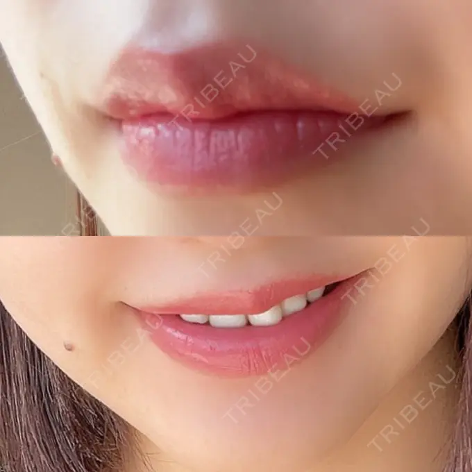 人中短縮 / ヒアルロン酸注入（唇） / ボトックス（口角） ルラ美容クリニック 高田馬場院 AFTER メイン用