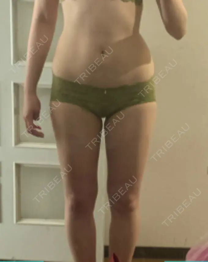 GLP-1ダイエット おおしま皮膚科 AFTER メイン用