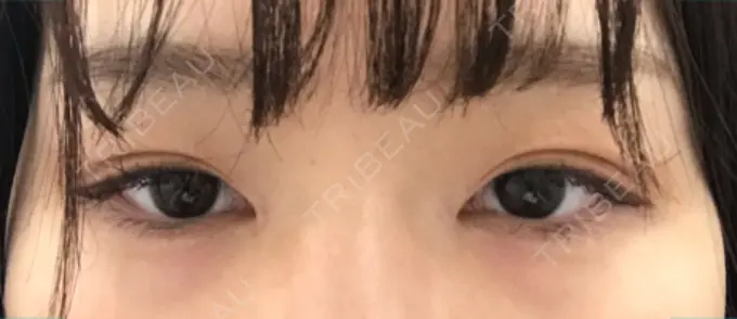 ヒアルロン酸注入（涙袋） フィラークリニック 横浜院 DAY 1 メイン用