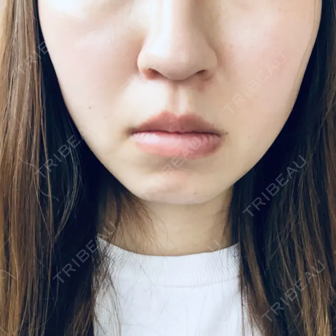 糸リフト 湘南美容クリニック 東京蒲田院 AFTER メイン用